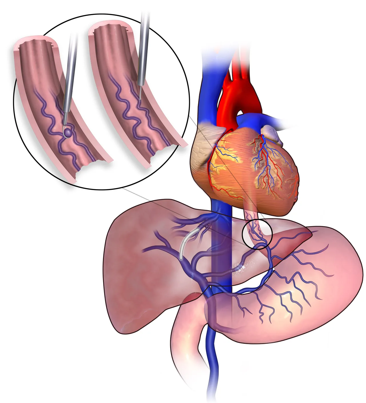 경화요법(sclerotherapy) 일러스트 - 정맥에 경화제를 주입하는 과정