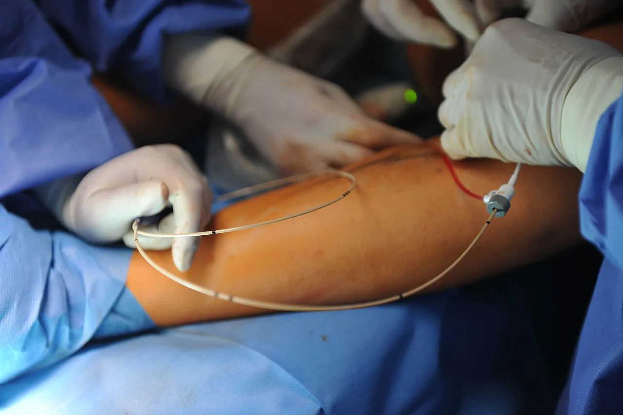 고주파 치료(radiofrequency ablation) - 하지정맥류 혈관 내 고주파 시술 장면