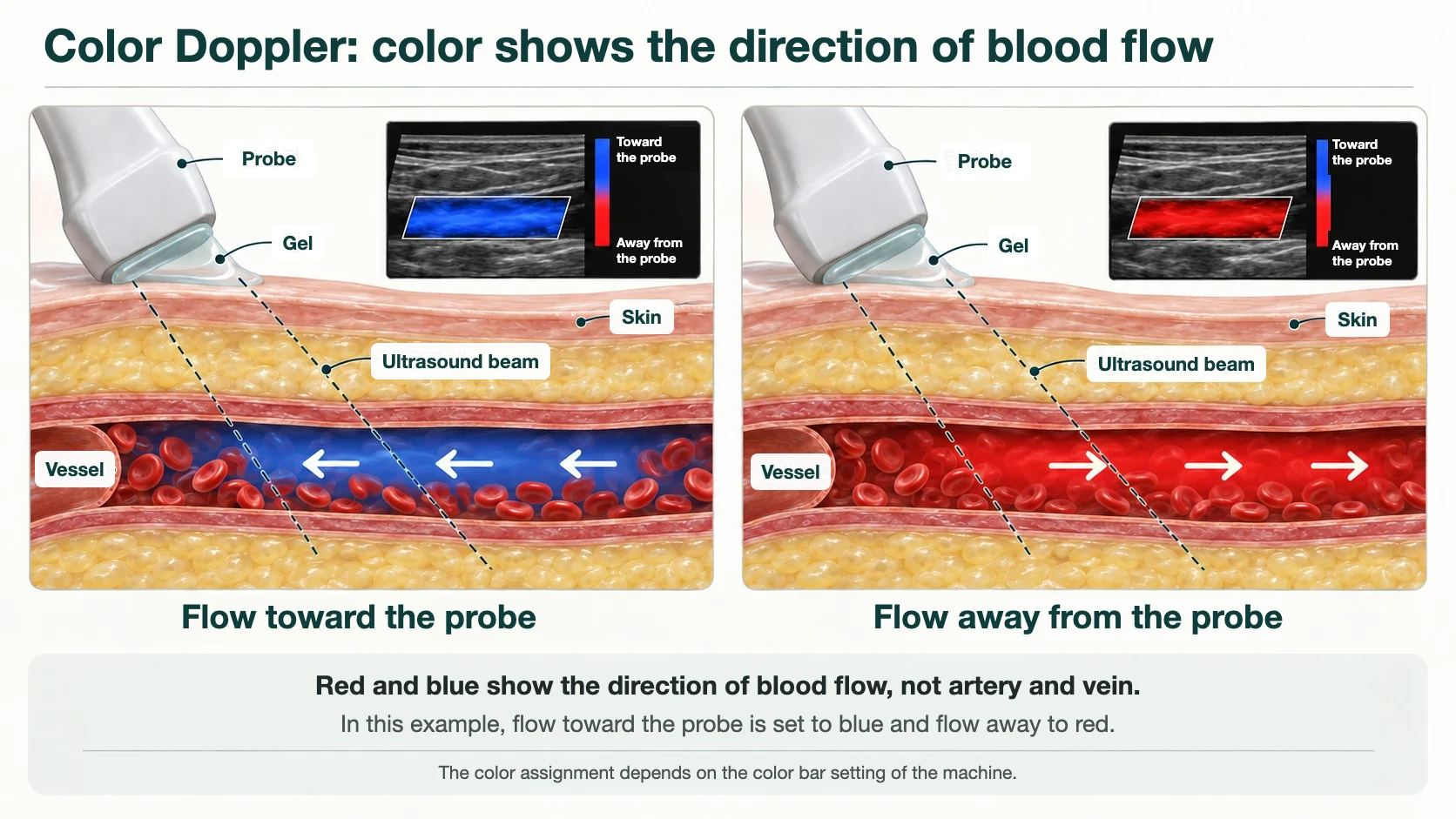 Diagram of color Doppler: in this example, flow toward the probe is shown in blue and flow away from the probe in red. The colors show the direction of blood flow, not artery and vein