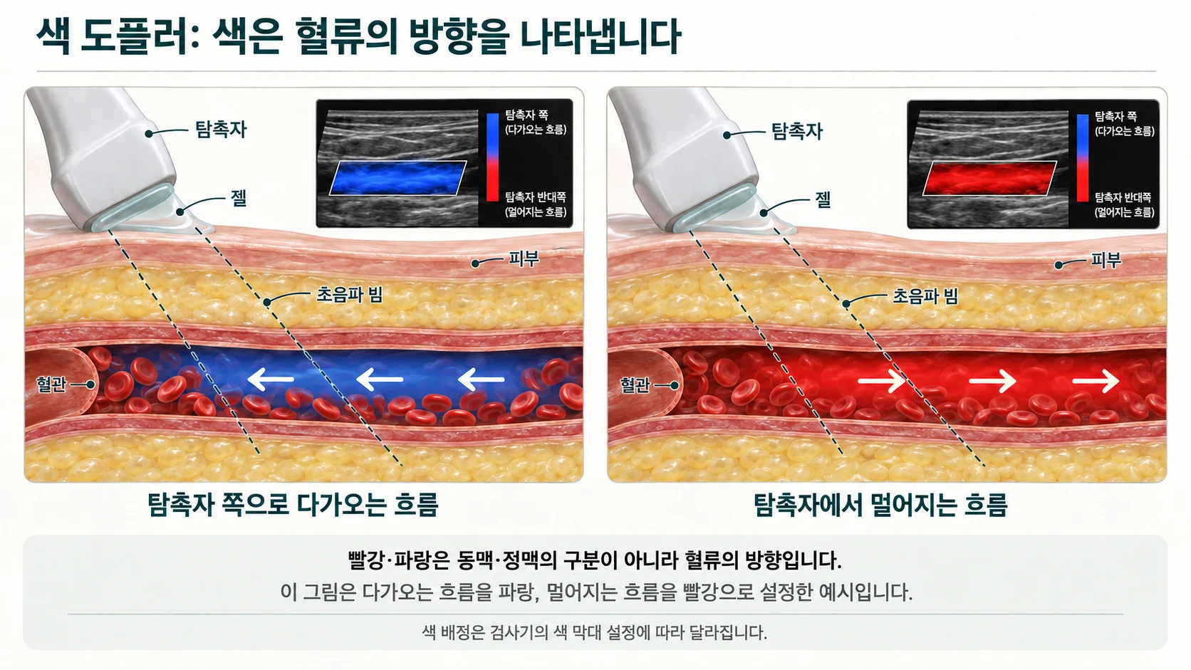 색 도플러 도해 — 탐촉자 쪽으로 다가오는 흐름은 파랑, 멀어지는 흐름은 빨강으로 설정한 예시. 색은 동맥·정맥의 구분이 아니라 혈류의 방향을 나타낸다