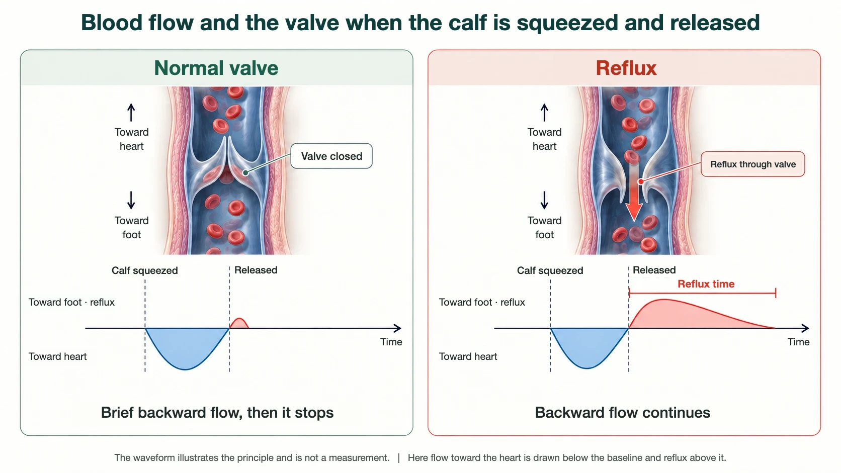 Blood flow and the valve when the calf is squeezed and released: with a normal valve, brief backward flow stops; with reflux, backward flow through the valve continues. Flow toward the heart is drawn below the baseline and reflux above it (illustrative waveform)