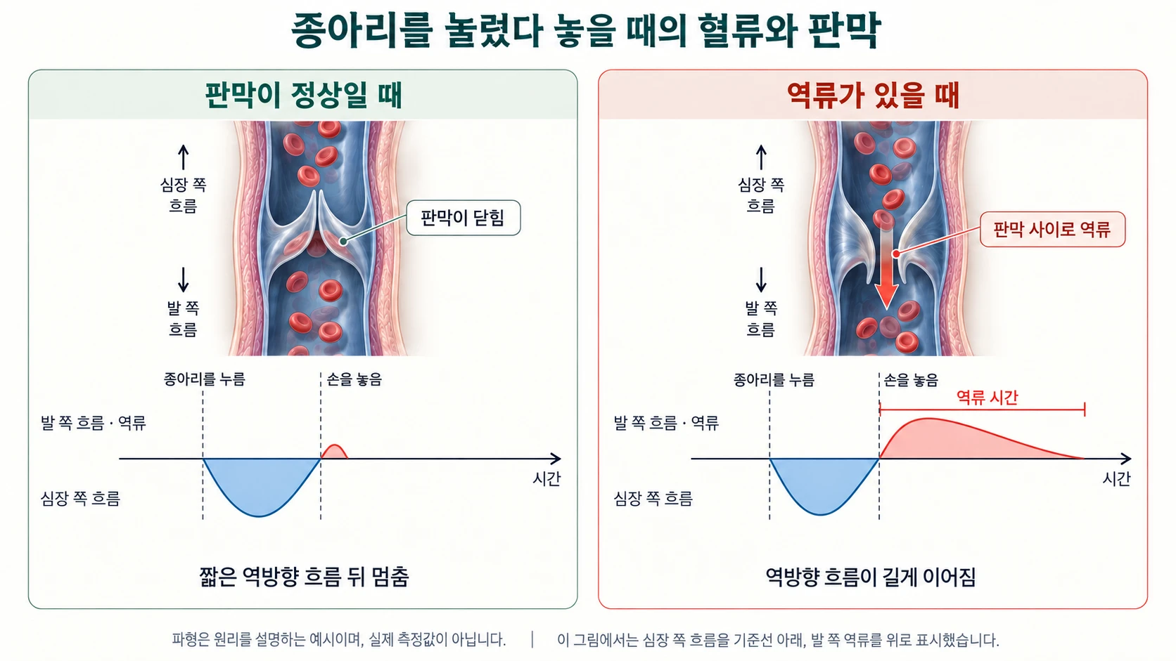 종아리를 눌렀다 놓을 때의 혈류와 판막 — 판막이 정상이면 짧은 역방향 흐름 뒤 멈추고, 역류가 있으면 판막 사이로 역방향 흐름이 길게 이어진다. 심장 쪽 흐름을 기준선 아래, 발 쪽 역류를 위로 표시한 예시 파형