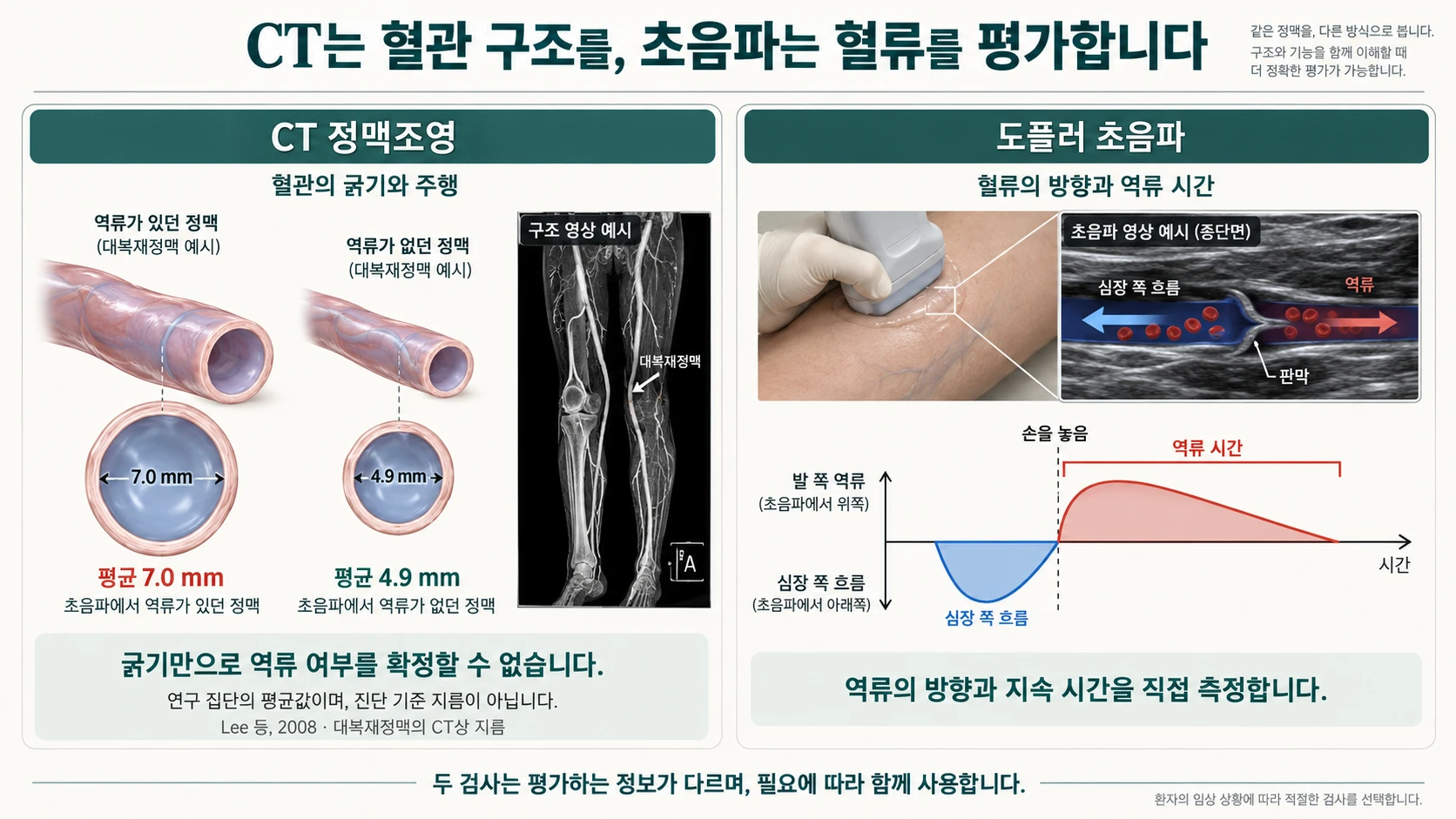 CT와 초음파 비교 — CT 정맥조영은 혈관의 굵기와 주행을 보여 주고(역류가 있던 정맥 평균 7.0mm, 없던 정맥 평균 4.9mm, Lee 등 2008), 도플러 초음파는 역류의 방향과 지속 시간을 직접 측정한다