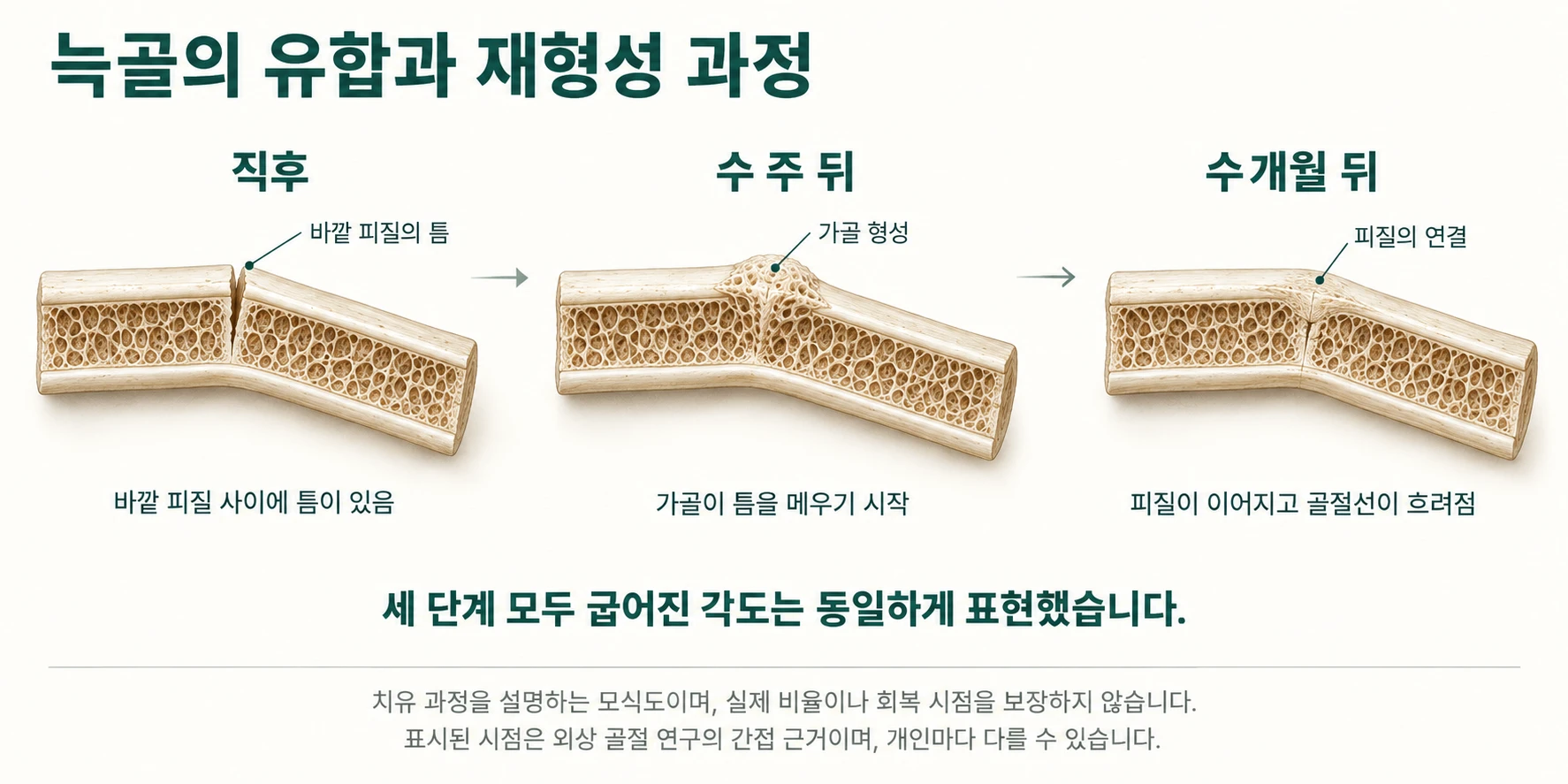 늑골의 유합과 재형성 과정 모식도. 직후에는 바깥 피질 사이에 틈이 있고, 수 주 뒤에는 가골이 틈을 메우기 시작하며, 수개월 뒤에는 피질이 이어지고 골절선이 흐려집니다. 세 단계 모두 굽어진 각도는 같게 그렸습니다.