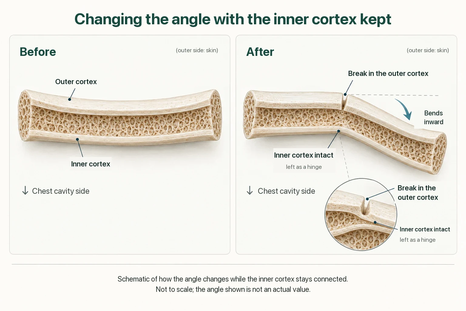 Two longitudinal sections of a rib. Before: outer and inner cortex both intact. After: the outer cortex is broken at one point, the inner cortex stays connected like a hinge, and the rib bends inward toward the chest cavity.