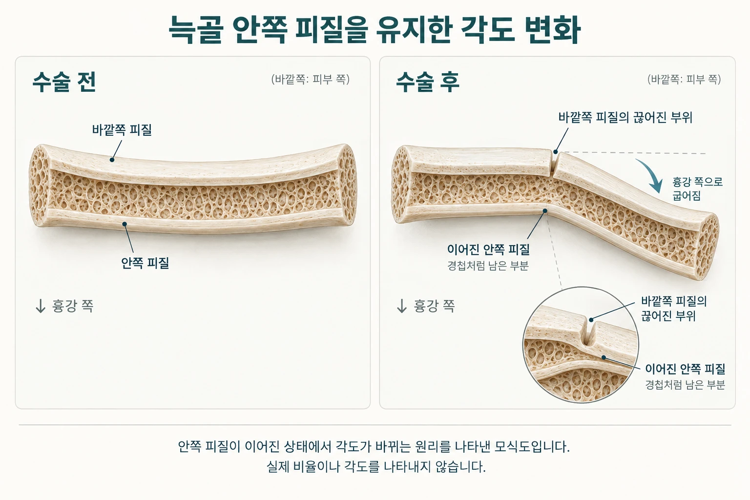 늑골 안쪽 피질을 유지한 각도 변화 모식도. 수술 전에는 바깥쪽 피질과 안쪽 피질이 모두 이어져 있습니다. 수술 후에는 바깥쪽 피질만 끊어지고 안쪽 피질은 경첩처럼 이어진 채 늑골이 흉강 쪽으로 굽어집니다.
